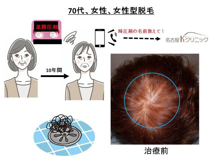 円形脱毛症　病院